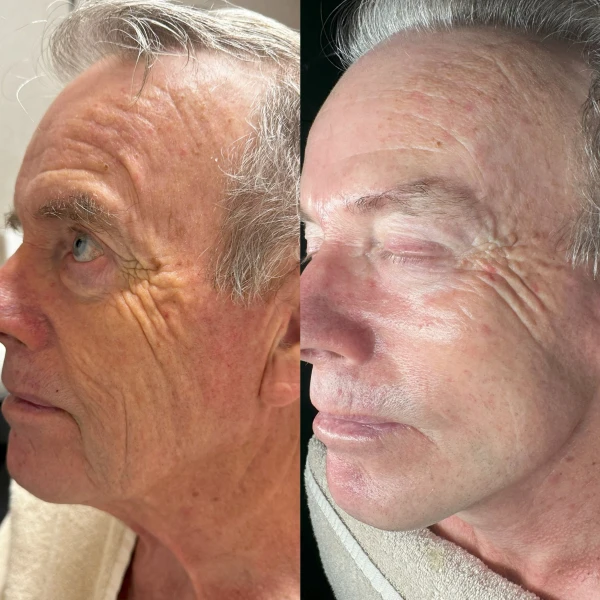 Superboost behandeling