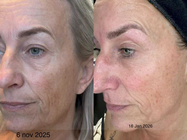 Superboost behandeling