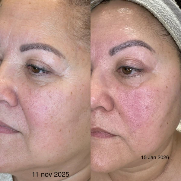 Superboost behandeling