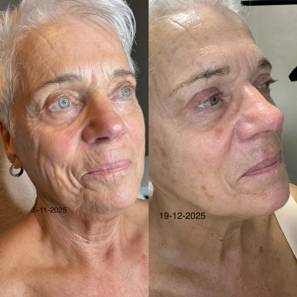 Superboost behandeling